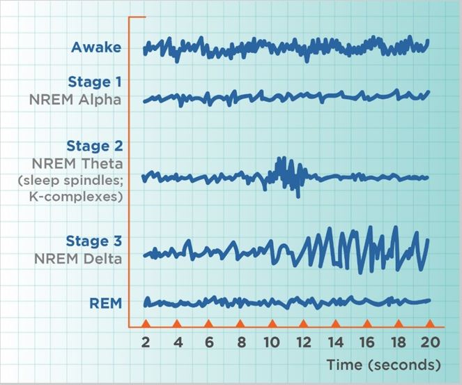 Hypnosis for insomnia - EEG recording during sleep